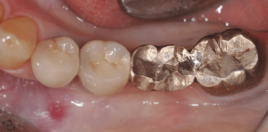 Socket Preservation 3.0: Sofortimplantation mit Keramikimplantaten