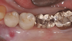 Socket Preservation 3.0: Sofortimplantation mit Keramikimplantaten