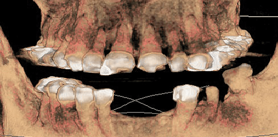 Dentinogenesis imperfecta ­hereditaria: Implantologische Möglichkeiten