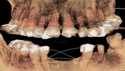 Dentinogenesis imperfecta hereditaria: Implantologische Möglichkeiten