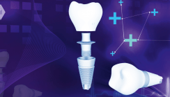 Dentalimplantate –  Luxus oder Notwendigkeit?