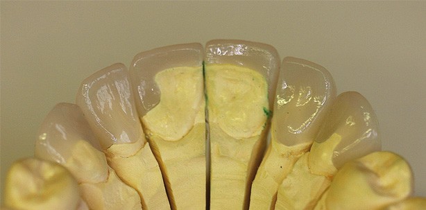 Oberkieferfrontversorgung mit Presskeramikveneers und Teilkronen