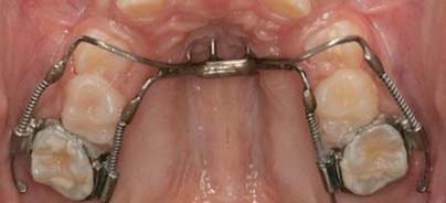 Knochengestützte Distalisationsgeräte