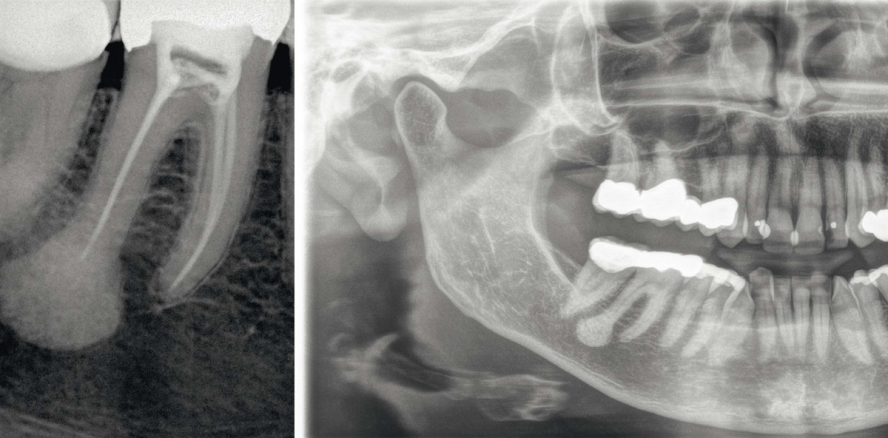 Aus der Praxis: Das komplexe Odontom