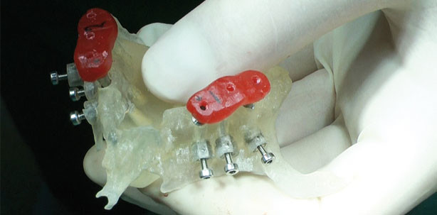 Vorteile, Risiken und Grenzen der digitalen Implantologie