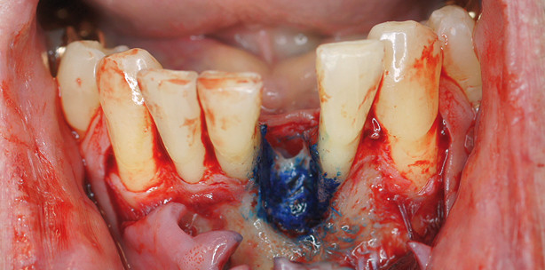 Minimalinvasive Rekonstruktion eines Unterkieferfrontzahnes