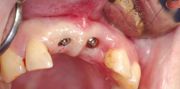 Struktur- und Volumenerhalt bei ­verzögerten Sofortimplantationen