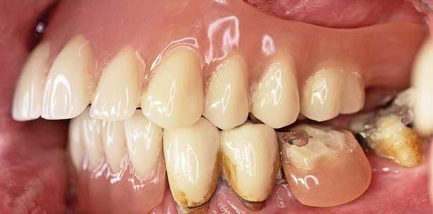 Implantatprothetische Versorgung des atrophierten Oberkiefers