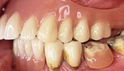 Implantatprothetische Versorgung des atrophierten Oberkiefers