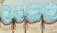 Tendenz geht zur Keramik auf Zirkondioxid