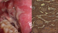 Oraler Lichen planus (OLP) und orale lichenoide Reaktion (OLR)