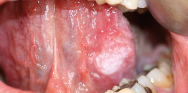Krebsfrüherkennung im Bereich von Mundhöhle und Lippen