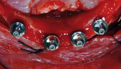 Sofortbelastung von transgingivalen Implantaten im zahnlosen Unterkiefer