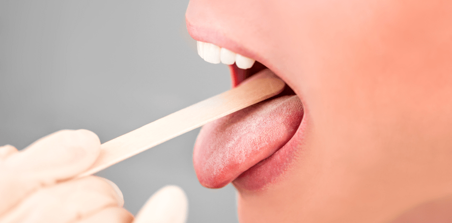 Orale Bakterien als Marker für Schizophrenie