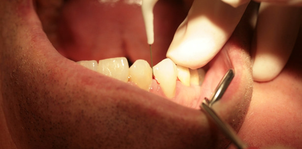 Neuartige Dentalsonde verkürzt Behandlungszeit