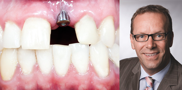 Implantate und Abutments: Original- und Nachahmerteile sicher kombinieren