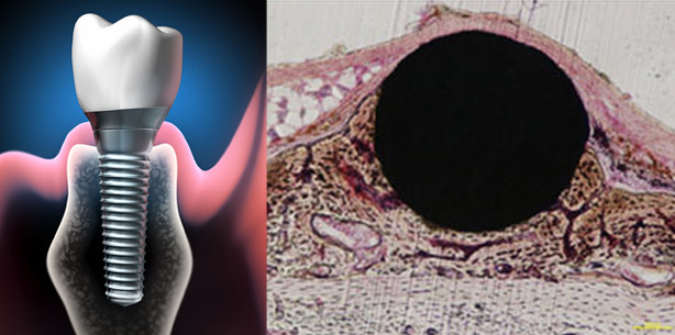 Neue Methode zur schnelleren Osseointegration entwickelt