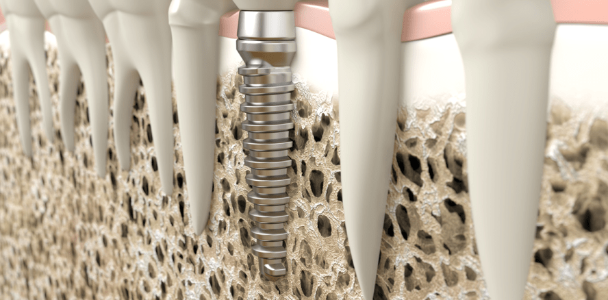 So wird die Osseointegration von Implantaten beschleunigt