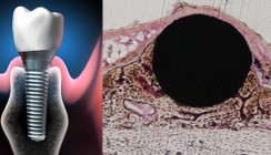Neue Methode zur schnelleren Osseointegration entwickelt
