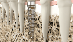 So wird die Osseointegration von Implantaten beschleunigt