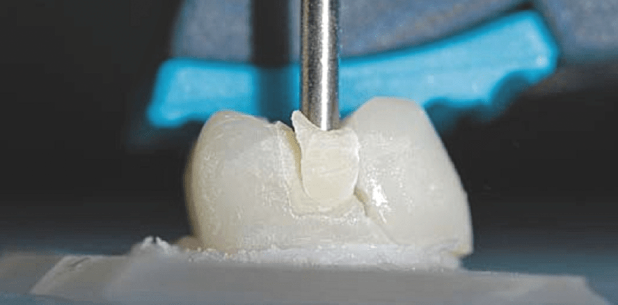 Vier Glasionomerzemente im Vergleich