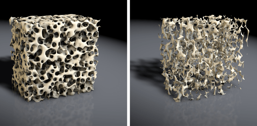 Heute ist Tag der Osteoporose