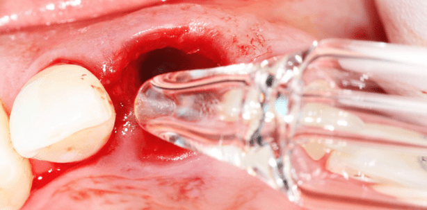 Protokoll einer Keramikimplantation nach Dr. Dominik Nischwitz