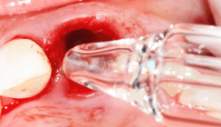 Protokoll einer Keramikimplantation nach Dr. Dominik Nischwitz