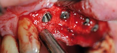 Implantatversorgung ohne Augmentation bei schräg atrophierten Processus alveolaris