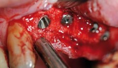 Implantatversorgung ohne Augmentation bei schräg atrophierten Processus alveolaris