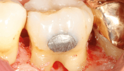 Schwere Parodontitis – bis wohin greift die PA-Therapie?