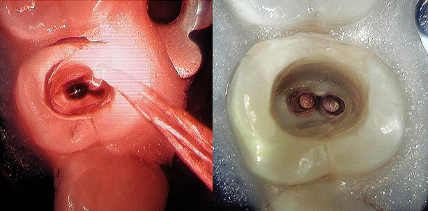 Die Photodynamische Therapie mit dem PACT®-System