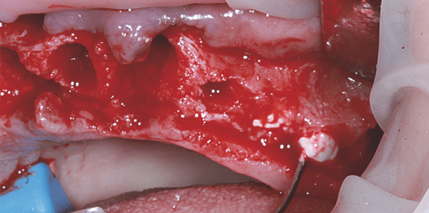 Anwendungsbeobachtung einer β-TCP-basierten ­Knochenersatzmaterialpaste
