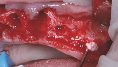 Anwendungsbeobachtung einer β-TCP-basierten Knochenersatzmaterialpaste