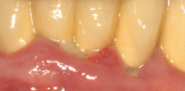 Aktuelle Behandlungsmethoden in der Parodontologie – Teil I