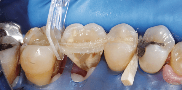 Zahnschienung nach Parodontaltherapie