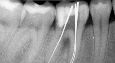 Grenzen der endodontischen Zahnerhaltung
