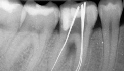 Grenzen der endodontischen Zahnerhaltung