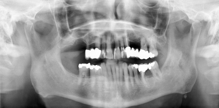 Aggressive und chronische Parodontitis