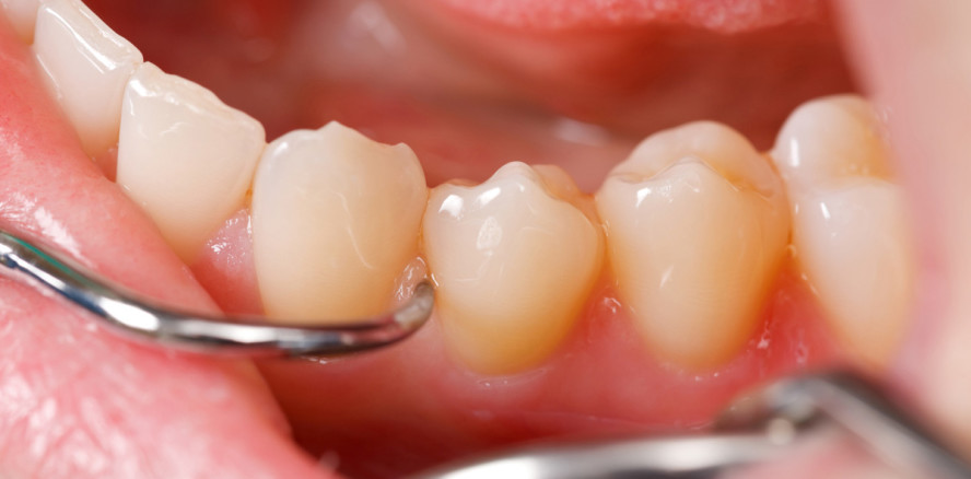 Therapie der parodontalen Entzündung und des Bone Remodeling – Therapeutisches Vorgehen