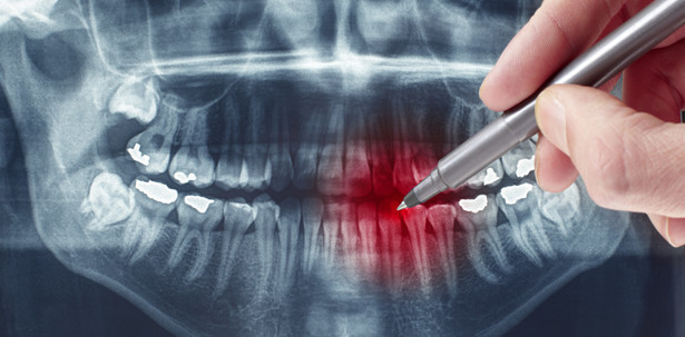 Parodontitis: die unbekannte Krankheit