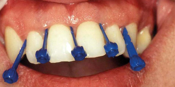 Parodontale Diagnostik und Therapie – ein Überblick