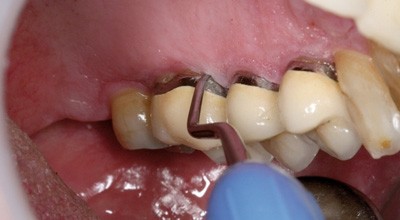 Behandlungsstrategien in der Parodontologie