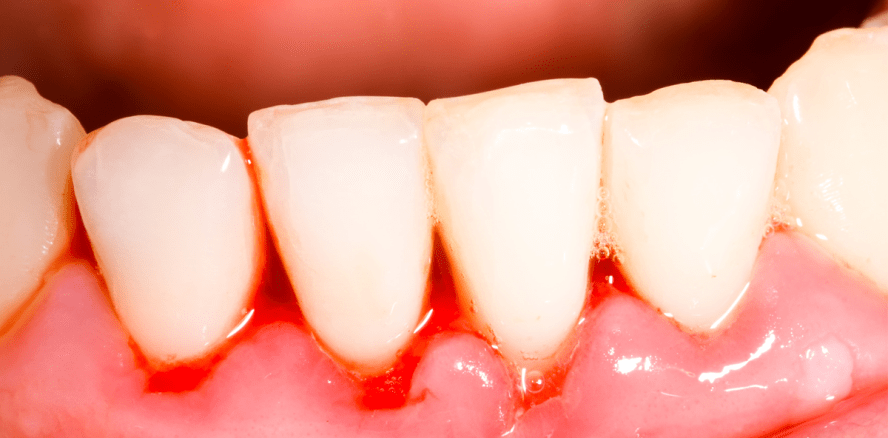 Adjuvante Antibiotika: Ist die klinische Diagnose ausreichend