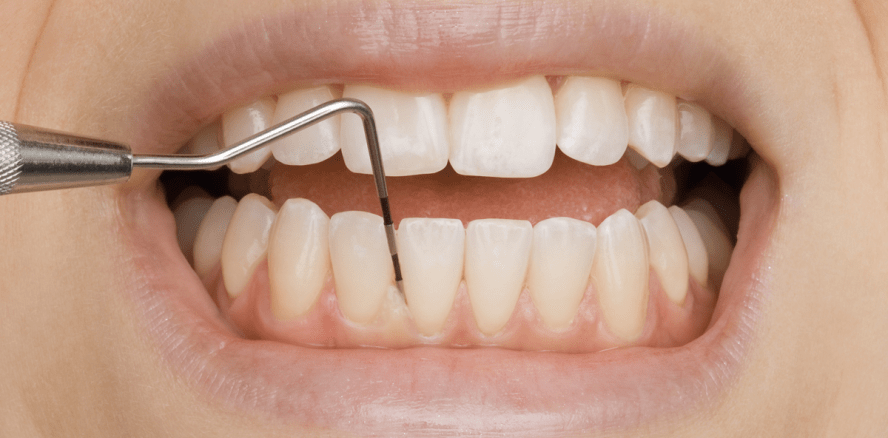 Ist bald Schluss mit Parodontitis?