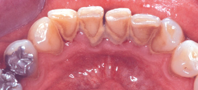 Ultraschallprinzip für die PAR-Therapie