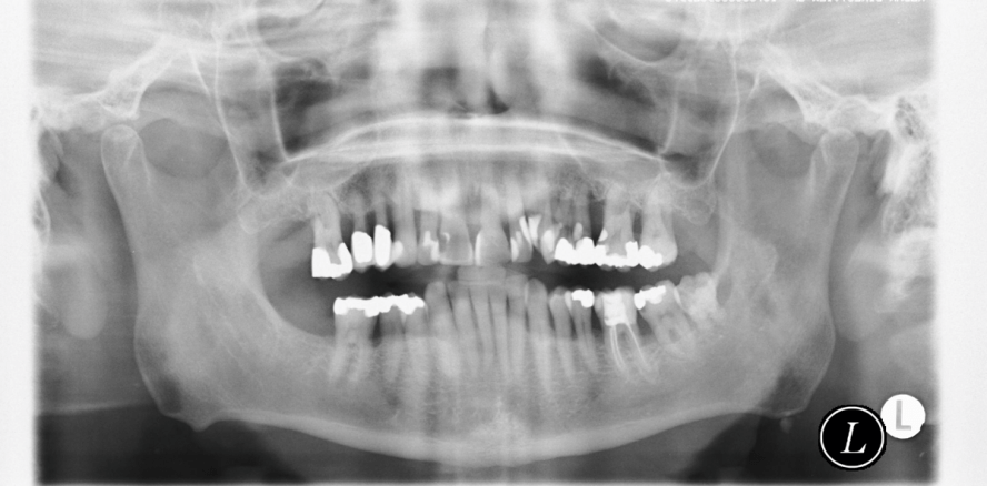 Aggressive und schwere chronische Parodontitis – eine therapeutische Herausforderung