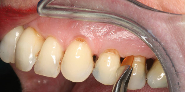 Parodontitis bei Patienten 50+