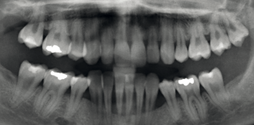 Parodontitis! Eine Erbkrankheit?
