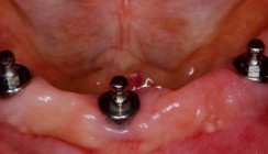 Gezielte Erhaltungstherapie in der Implantatprothetik